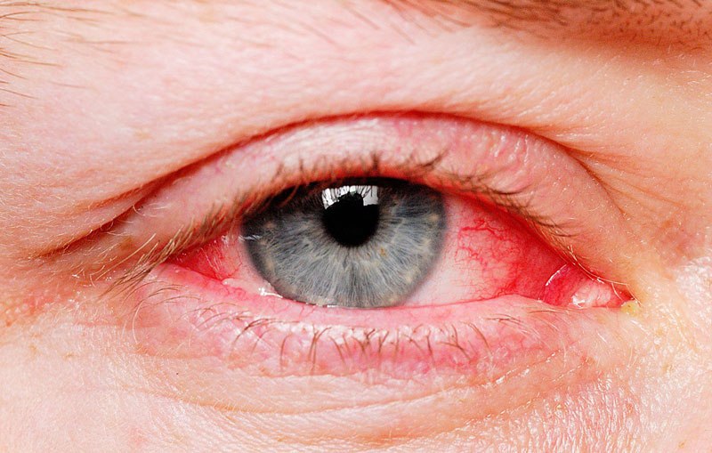 Viêm kết mạc là tình trạng viêm lớp mô mỏng trong suốt nằm trên phần tròng trắng của mắt và lót bên trong mí mắt (hay còn gọi là kết mạc). Khi các mạch máu nhỏ trong kết mạc sưng lên và bị kích thích sẽ làm cho tròng trắng của mắt có màu đỏ hoặc hồng. 